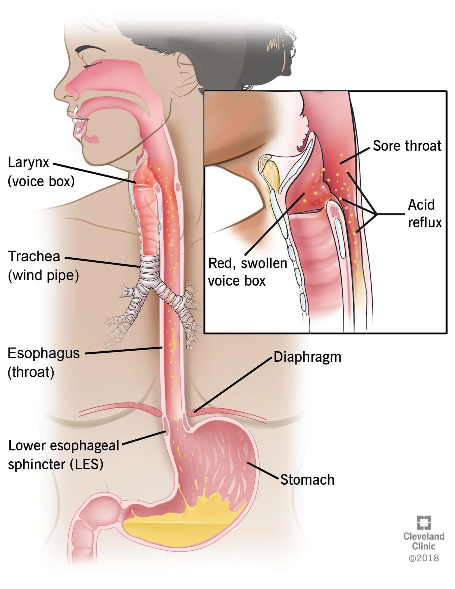 How I Cured My Silent Reflux All You Need To Know About Silent Reflux